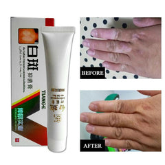 Chinese Medical White Spot Disease Cream Pigment Vitiligo Leukoplakia Disease Treatment Melanin Promoting Liniment Skin 30g
