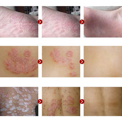 Pifubaodian Powerful Original Psoriasis Dermatitis Eczema Pruritus Skin Problems Cream With Retail Box Skin Care Plaster