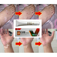 Chinese Medical White Spot Disease Cream Pigment Vitiligo Leukoplakia Disease Treatment Melanin Promoting Liniment Skin 30g