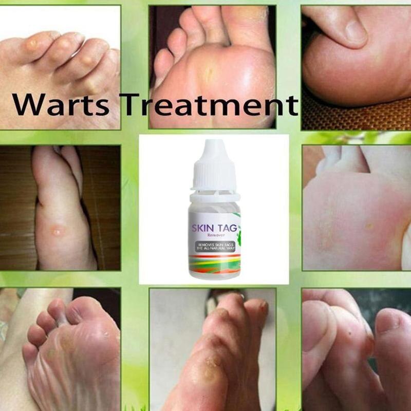 10ML Body Warts Treatment Cream Skin Tag Remover Foot Corn Removal Plantar Genital Warts Ointment Foot Care Cream Dropshopping Secondary image