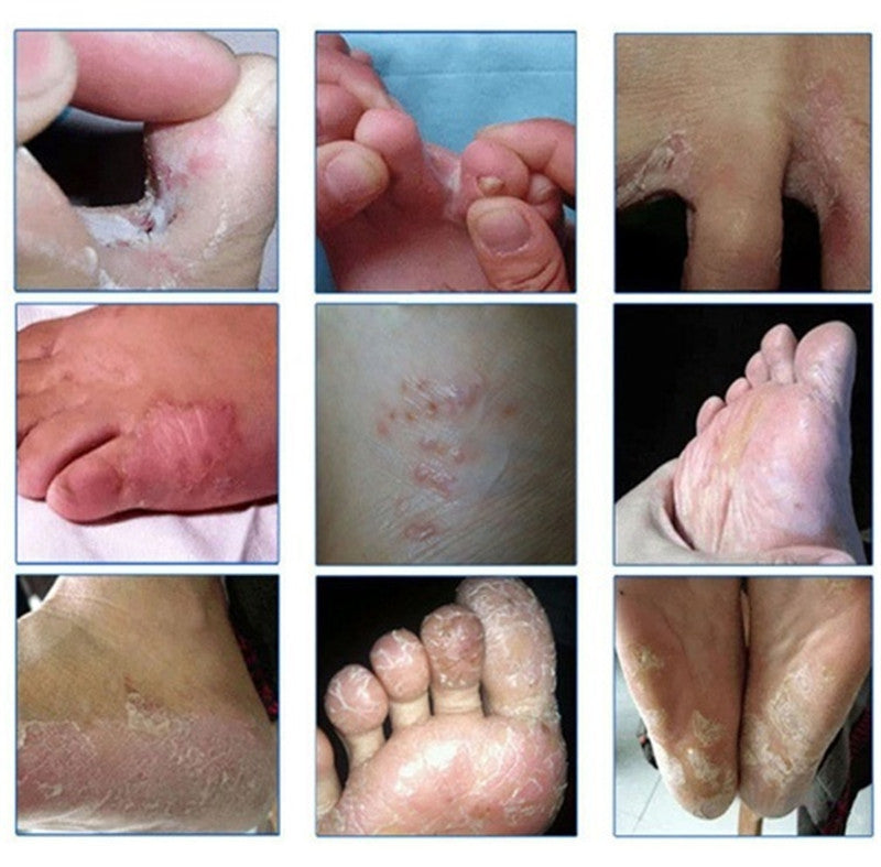 Fungal Infections Foot Bath Powder Feet Care Athlete's Foot, Foot Odor, Sweat, Itching, Peeling, Beriberi 10pcs/lot