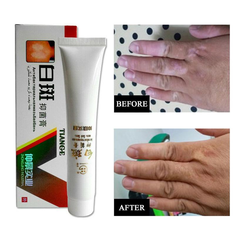 Chinese Medical White Spot Disease Cream Pigment  Vitiligo Leukoplakia Disease Treatment Melanin Promoting Liniment Skin 30g Main image