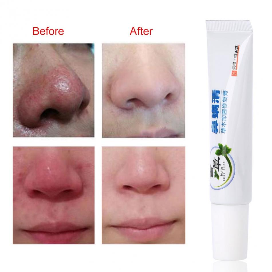 Nose Massage Tools Rosacea Treatment Cream Nose Redness Removal Cleaning Antibacterial Gel Skin Care Product Main image