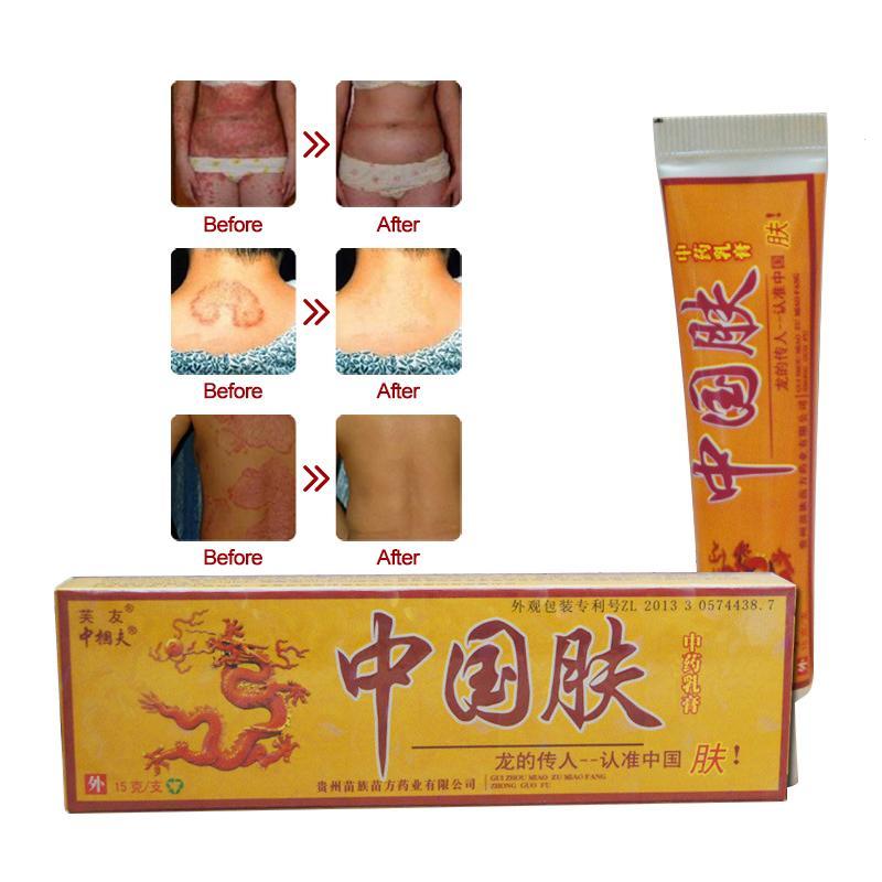 Natural Chinese Medicine Herbal Anti Bacteria Cream Psoriasis Eczema Ointment Skin Problem Repair Treatment Health Care 15g