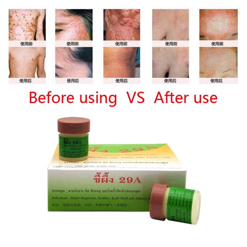 1pc Psoriasis Eczma Cream Works Perfect For All Kinds Of Skin Problems Patch Body Massage Ointment Chinese Medicine Main image