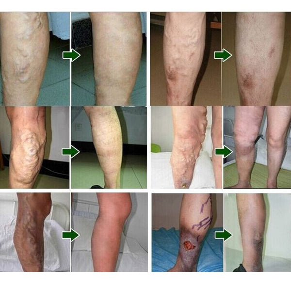24 Pcs Spider Veins Varicose Treatment Plaster Varicose Veins Cure Patch Vasculitis Natural Solution Herbal Patches