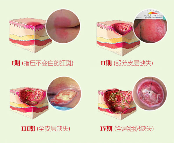 1PC Herbal Removal Rot Myogenic Cream Bedsores Paste Treat Pressure Sores/Decubituses/Pressure Ulcer Festering Wound Healing