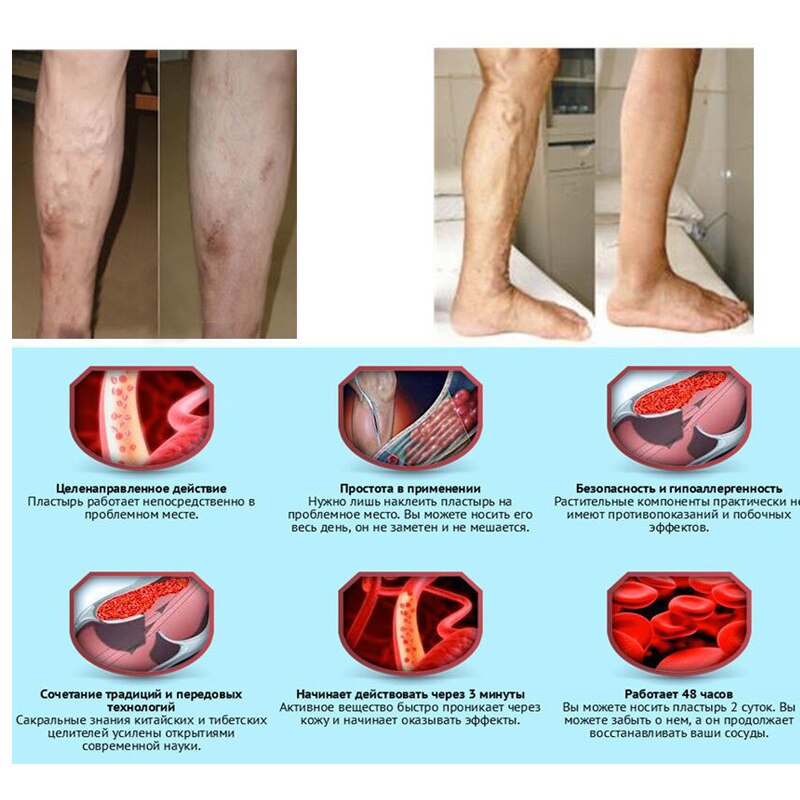 24 Pcs Spider Veins Varicose Treatment Plaster Varicose Veins Cure Patch Vasculitis Natural Solution Herbal Patches Secondary image