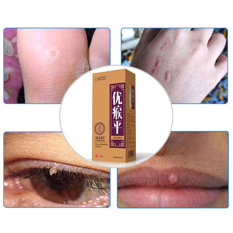 Skin Tag Remover Pen 12 hours Tu kill Medical Tu kill Remover Skin Tag Mole & Genital Wart Remover Foot Corn Removal Pen Main image