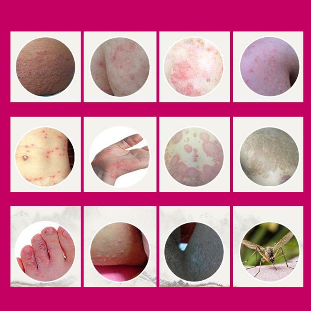 Medical psoriasis Cream Dermatitis Eczema Hand Foot and Ringworm Tinea versicolor  Hemorrhoids Treatment Ointment Health Care Secondary image