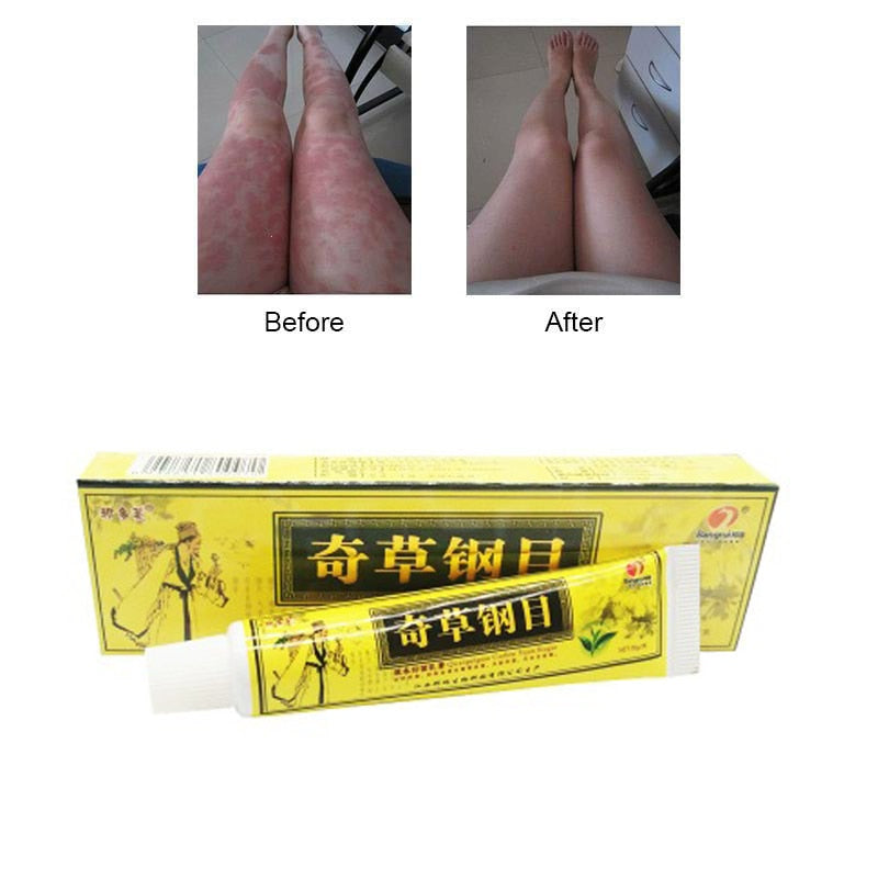 1pc Skin Psoriasis Cream Dermatitis Eczematoid Eczema Ointment Treatment Psoriasis Cream Skin Care Cream medical plaster Secondary image