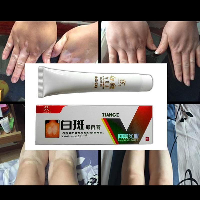 Chinese Medical White Spot Disease Cream Pigment  Vitiligo Leukoplakia Disease Treatment Melanin Promoting Liniment Skin 30g