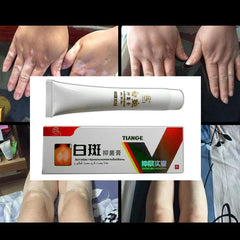 Chinese Medical White Spot Disease Cream Pigment  Vitiligo Leukoplakia Disease Treatment Melanin Promoting Liniment Skin 30g