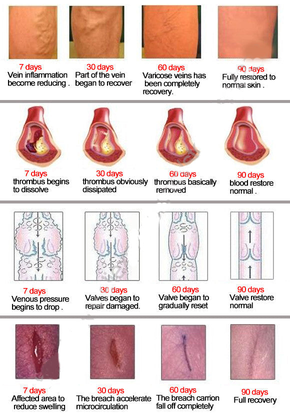 Varicose Veins ointment eins Varicose Treatment Plaster Varicose Veins Cure Patch Vasculitis Natural Solution Herbal Patches