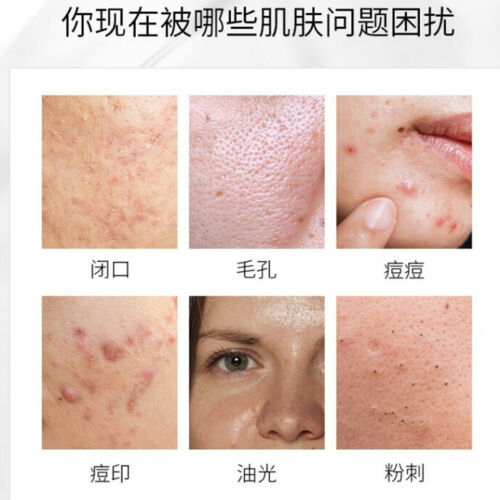 Salvia Aloe Acne cream Reduce Scar 仁和药业 丹参芦荟祛痘凝胶 淡化痘印 祛痘印去痘疤修复