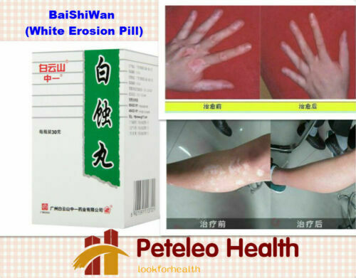 3 Packs BaiShiPills Skin Repigment TCM Therapy BAIYUNSHAN Vitiligo Treatment Secondary image